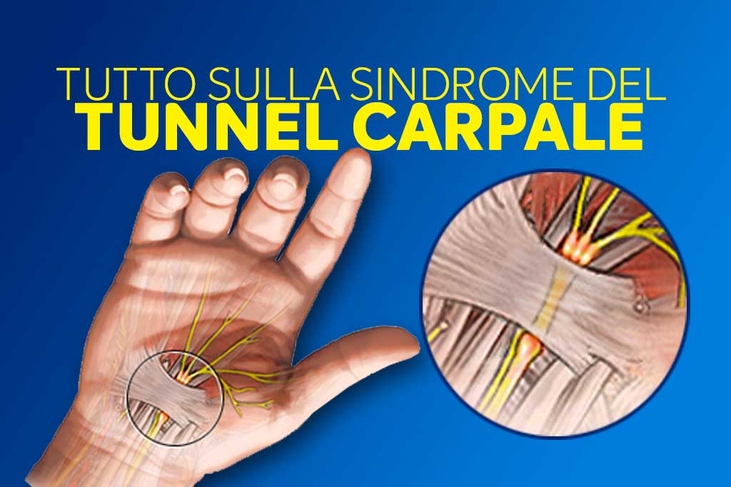 Tunnel-Carpale.jpg
